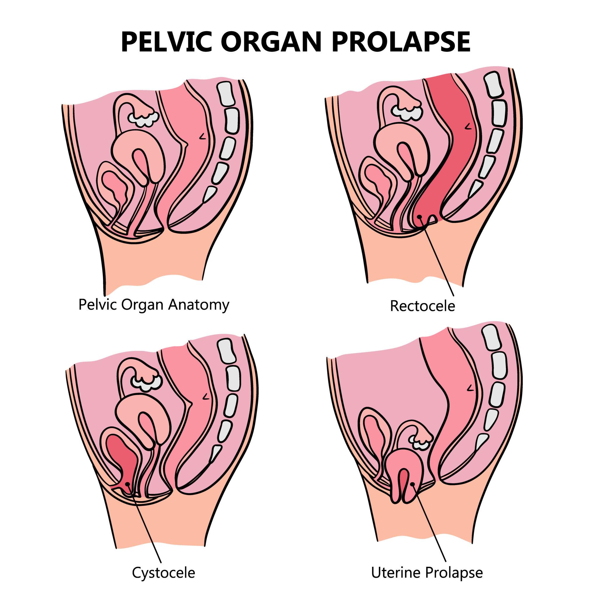 Laparoscopic Hysteropexy in Pune – Uterus Prolapse Treatment Without Removal